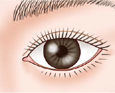 施術前：涙袋が出すぎた状態